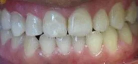 Composite Fillings — Case 1 after treatment