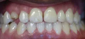 Composite Fillings — Case 1 before treatment