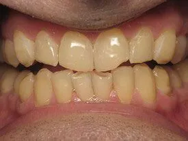 Composite Fillings — Case 2 before treatment
