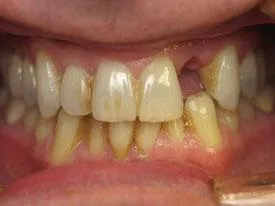 Implant Dentistry before treatment