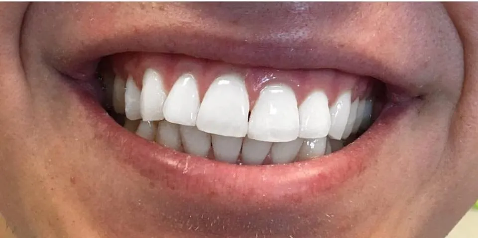 Aesthetic Trimming & Whitening after treatment